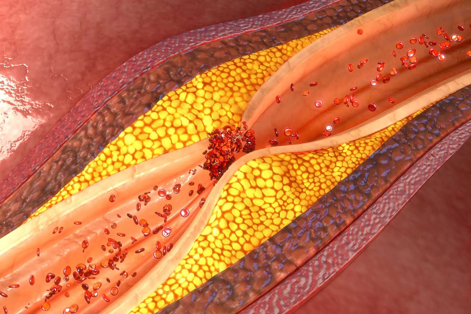 الانسداد الدموي والشلل فهم التحديات وتطبيق التمارين لتحسين الجودة الحياتية