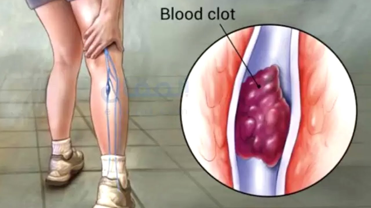 الجلطات الدموية والاضطرابات الحركية تمارين واستراتيجيات للتعافي 1 الجلطات الدموية والاضطرابات الحركية تمارين واستراتيجيات للتعافي