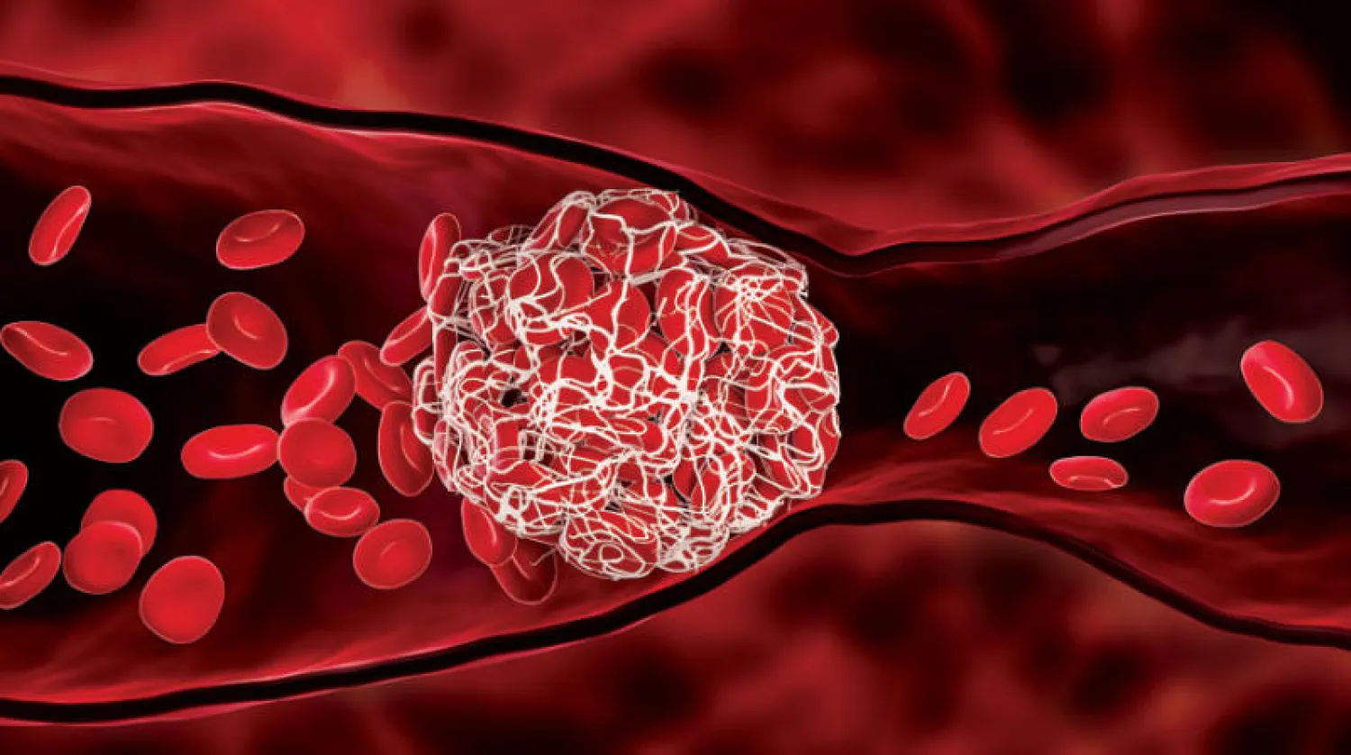 الخثرات الدموية وفقدان الحركة كيفية استعادة الحركة من خلال التمارين التأهيلية